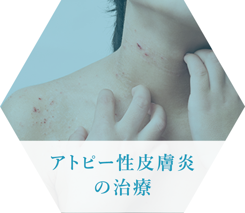 アトピー性皮膚炎の治療